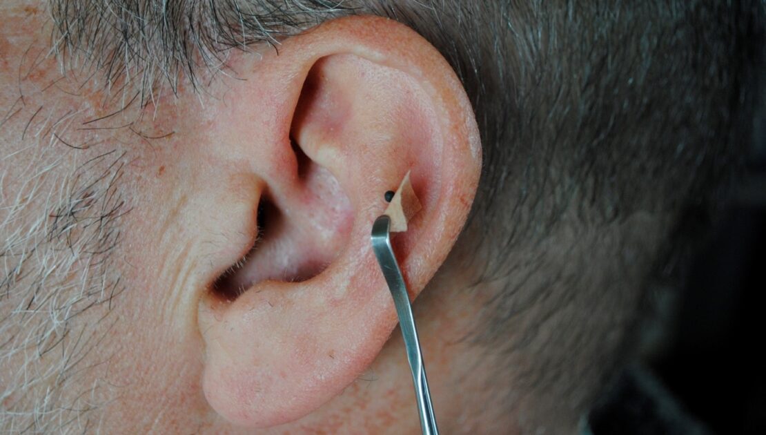 Close-up van een auriculotherapie-behandeling aan het uitwendig oor